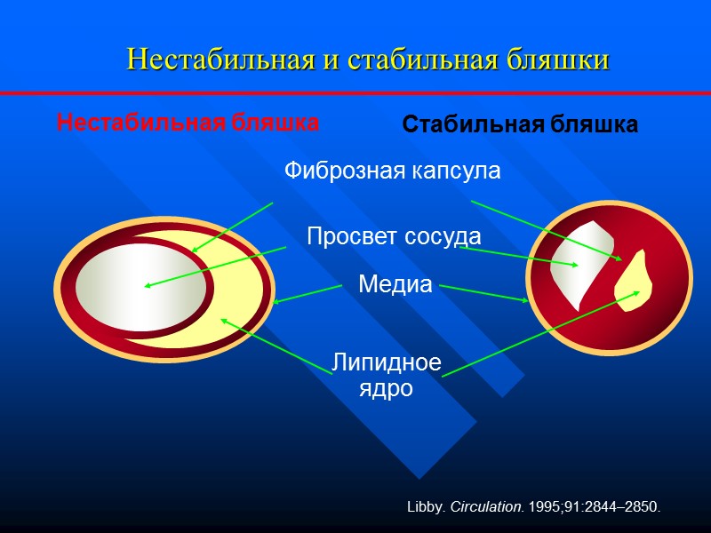 Libby. Circulation. 1995;91:2844–2850. Фиброзная капсула Meдиa Просвет сосуда Липидное ядро Нестабильная бляшка Стабильная бляшка Libby. Circulation. 1995;91:2844–2850. Фиброзная капсула Meдиa Просвет сосуда Липидное ядро Нестабильная бляшка Стабильная бляшка